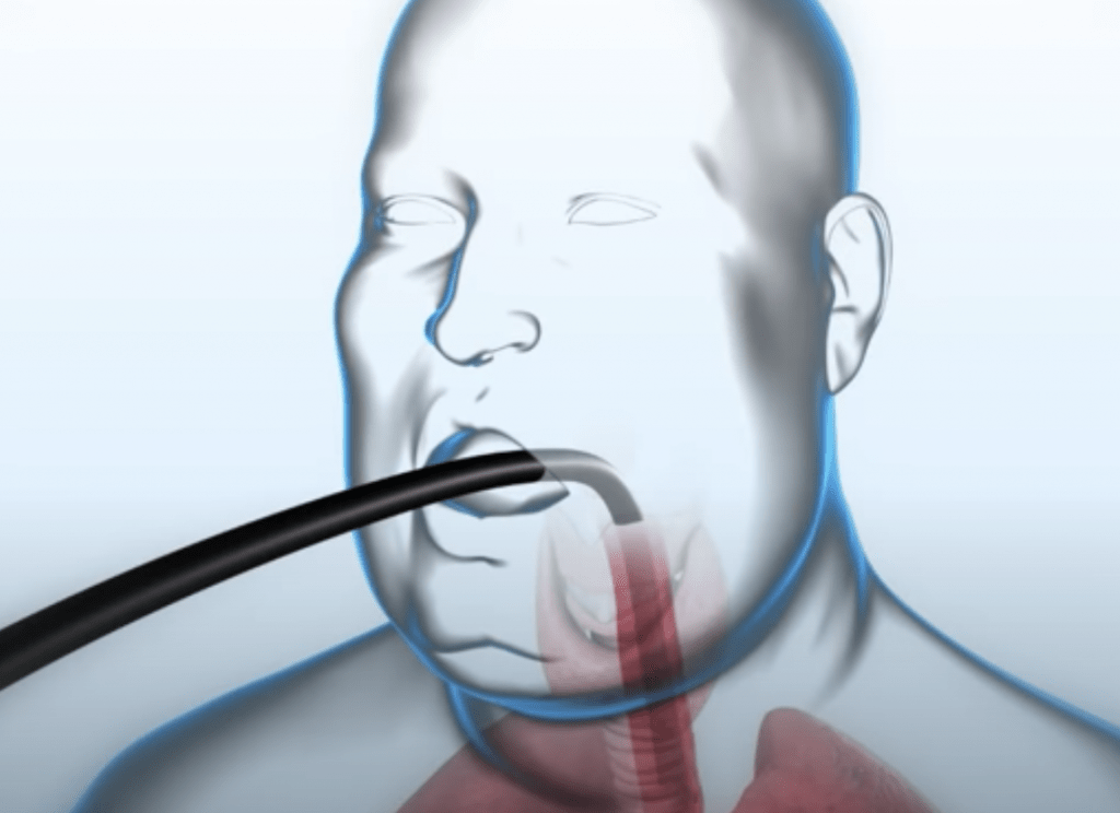 שרוול אנדוסקופי צינור שחור תפירת קיבה הצרת קיבה ללא ניתוח
